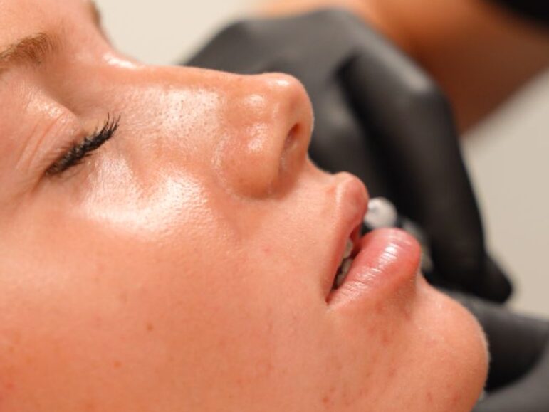dermal filler for cheeks