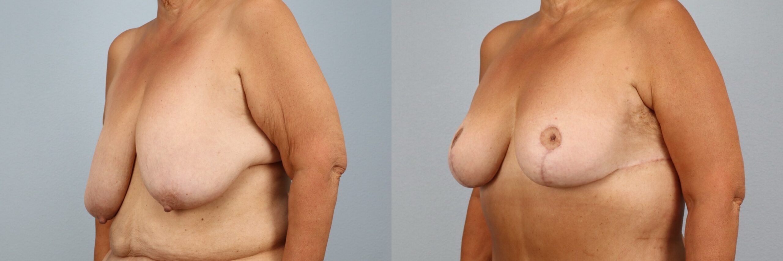 Before and after – Breast Reduction – Female patient, age 60+ – Image 2