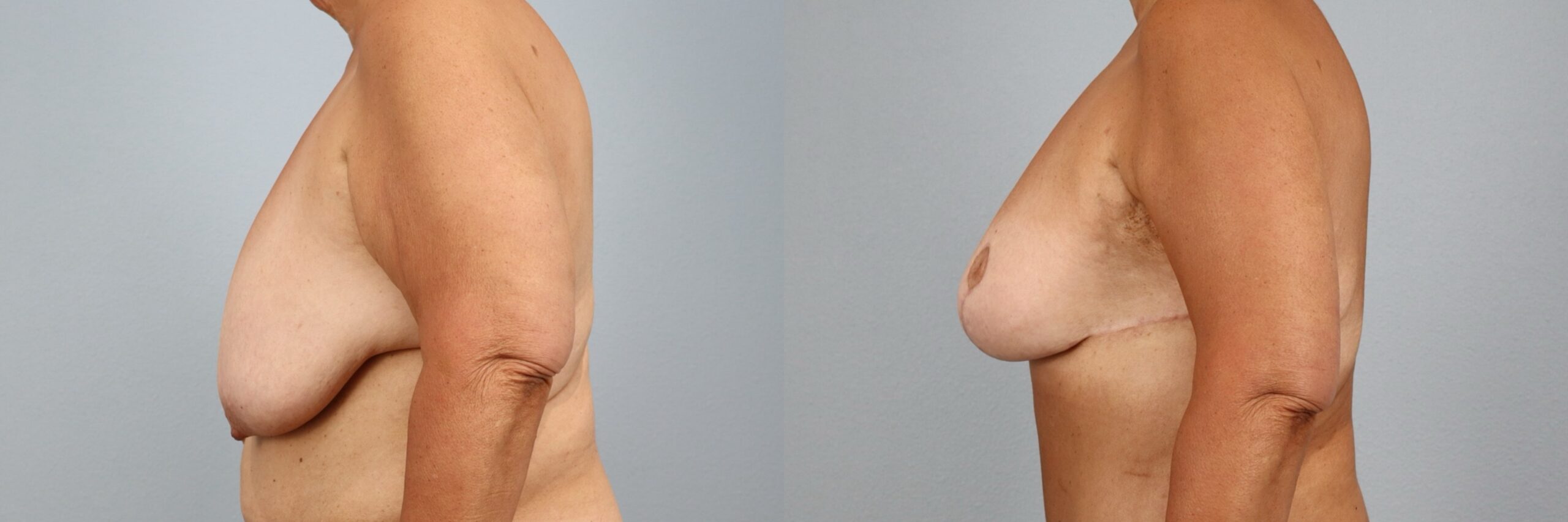 Before and after – Breast Reduction – Female patient, age 60+ – Image 3