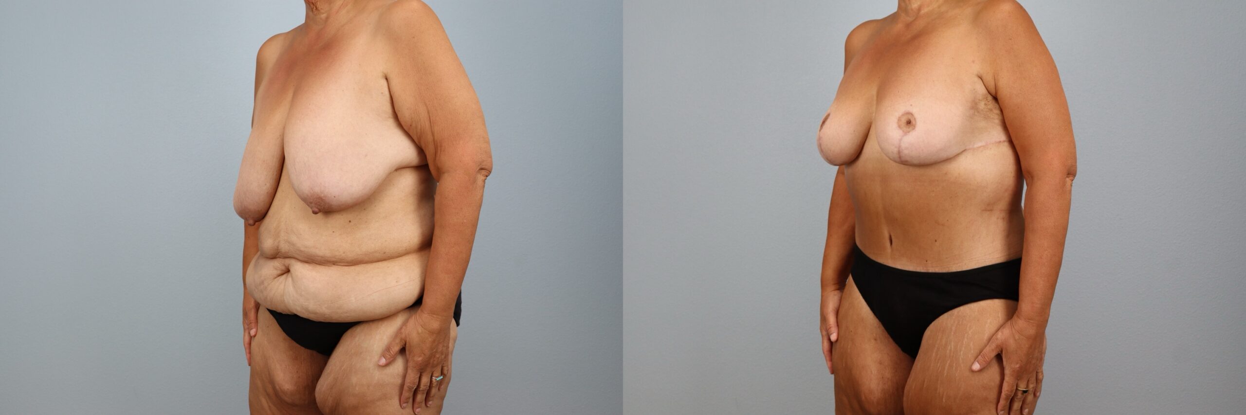 Before and after – Body Contouring – Female patient, age 60+ – Image 44