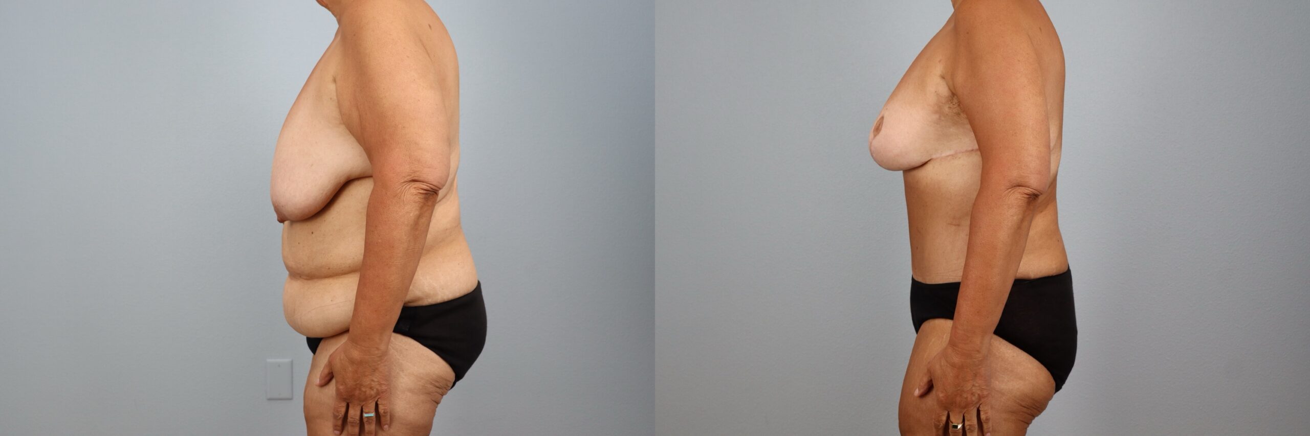 Before and after – Body Contouring – Female patient, age 60+ – Image 45