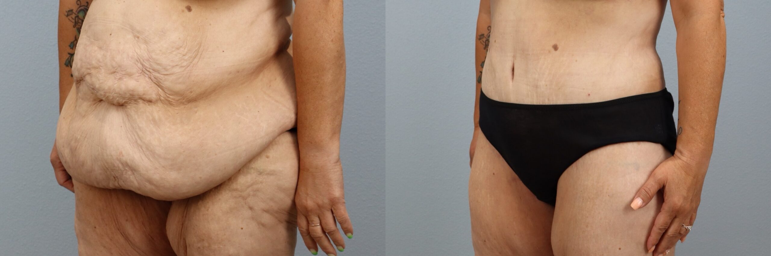 Before and after – Body Contouring – Female patient, age 50-59 – Image 19