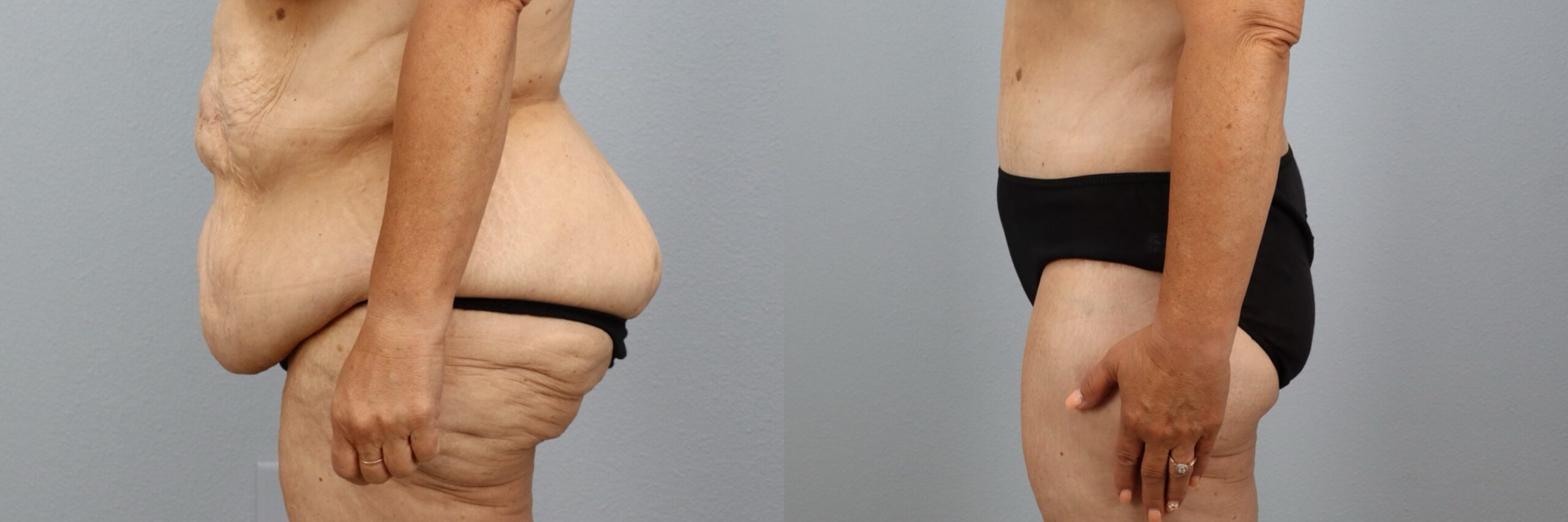Before and after – Body Contouring – Female patient, age 50-59 – Image 20