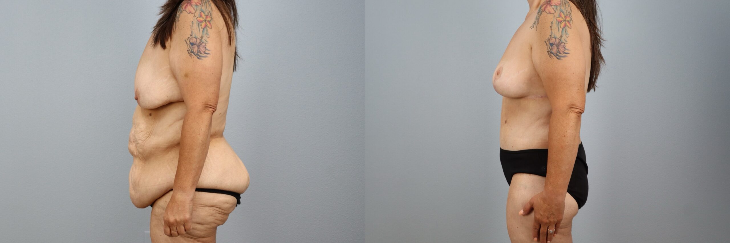 Before and after – Body Contouring – Female patient, age 50-59 – Image 42