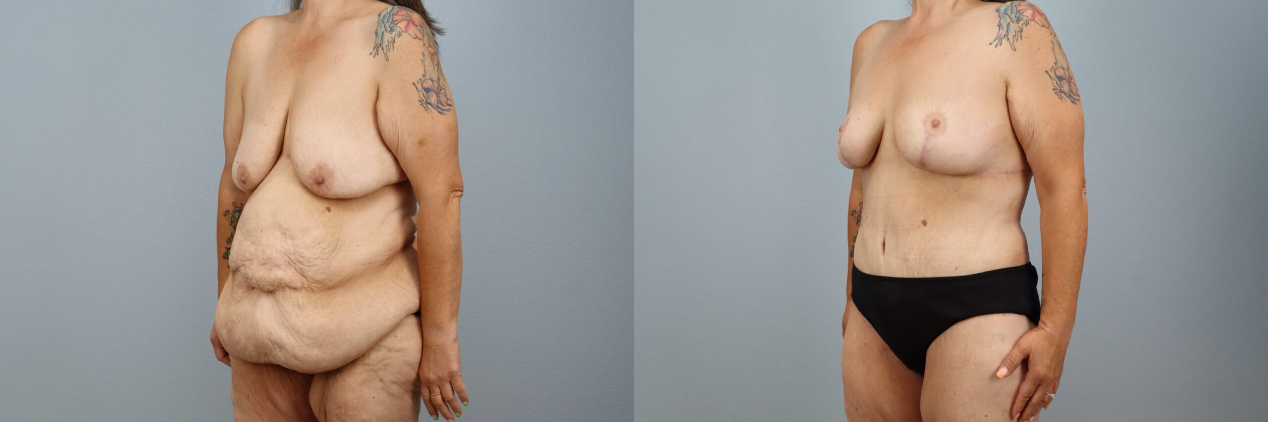 Before and after – Body Contouring – Female patient, age 50-59 – Image 41
