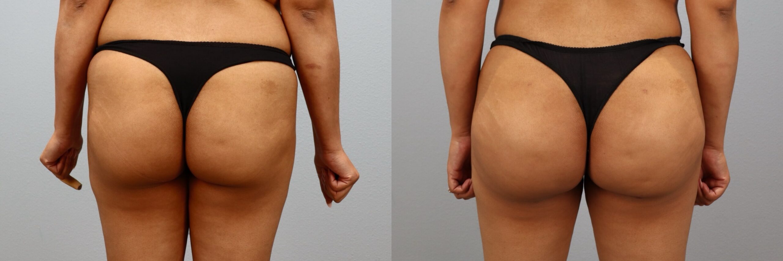 Before and after – Body Contouring – Female patient, age 30-39 – Image 20
