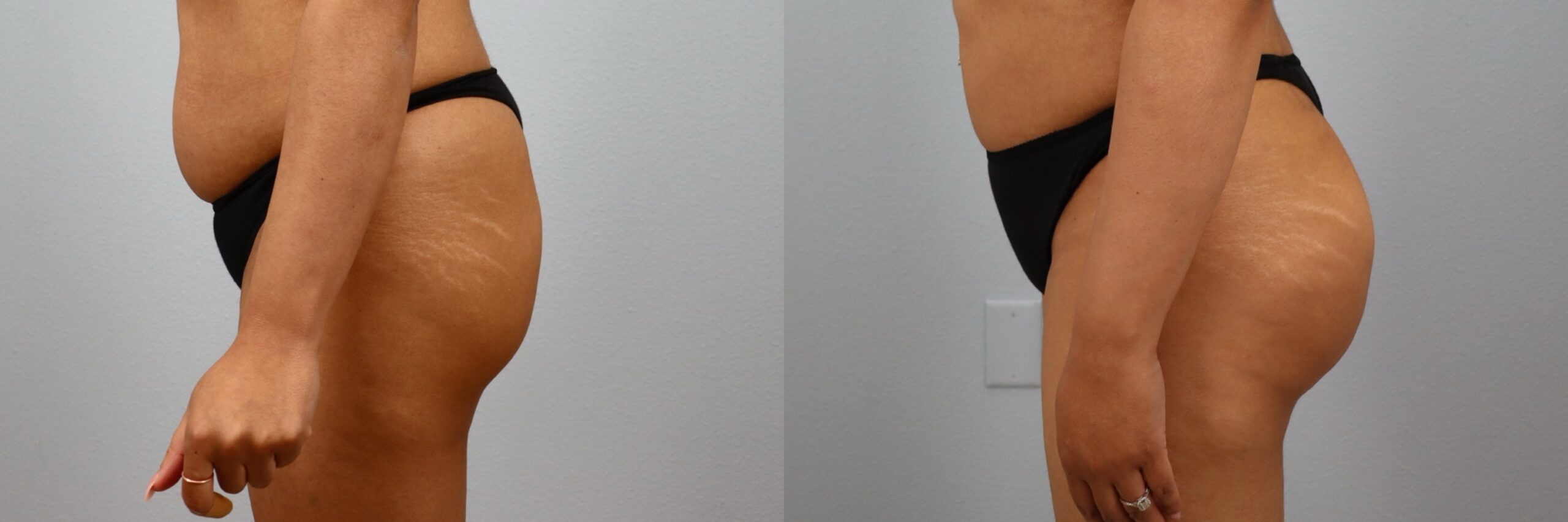 Before and after – Body Contouring – Female patient, age 30-39 – Image 19
