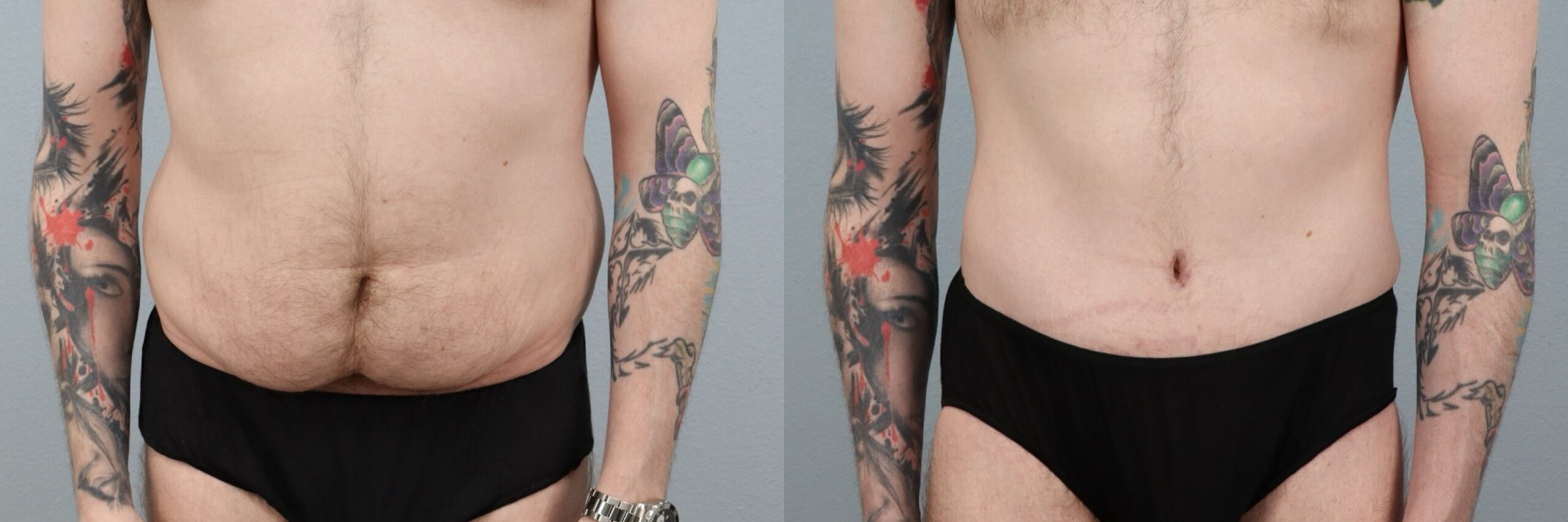 Before and after – Tummy Tuck Men – Male patient, age 30-39 – Image 4