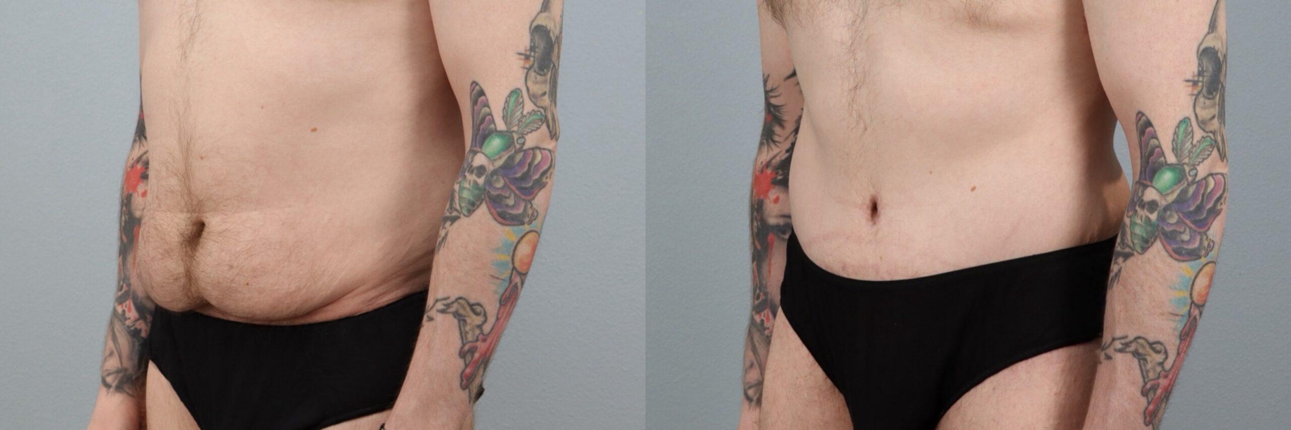 Before and after – Tummy Tuck Men – Male patient, age 30-39 – Image 5