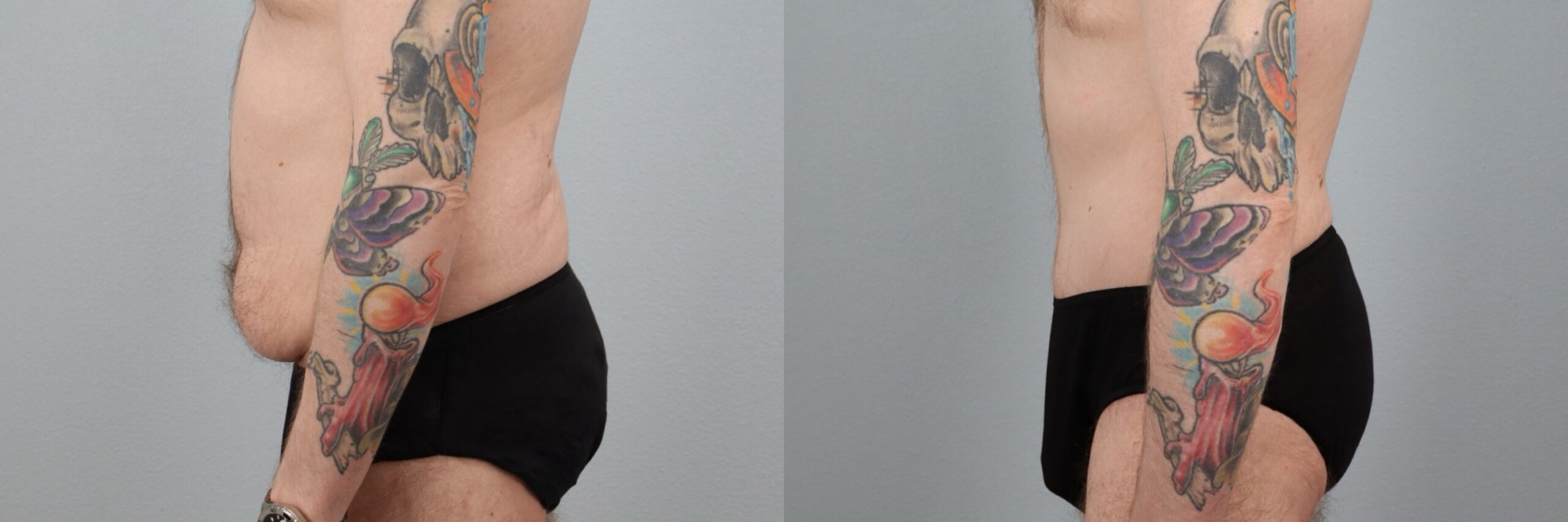 Before and after – Tummy Tuck Men – Male patient, age 30-39 – Image 6