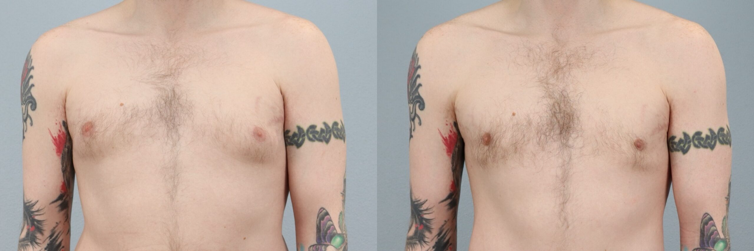 Before and after – Male Surgery – Male patient, age 30-39 – Image 16