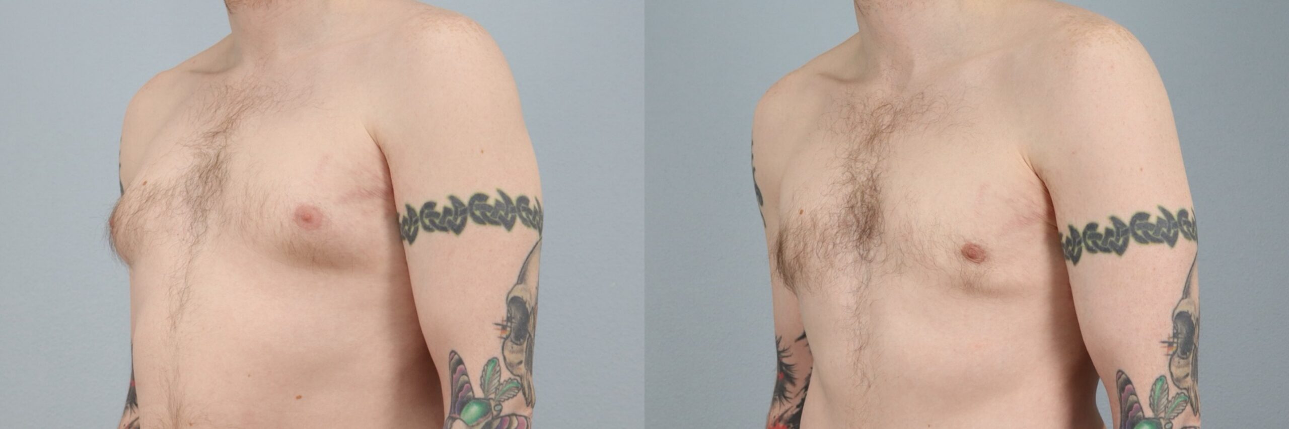 Before and after – Male Surgery – Male patient, age 30-39 – Image 17