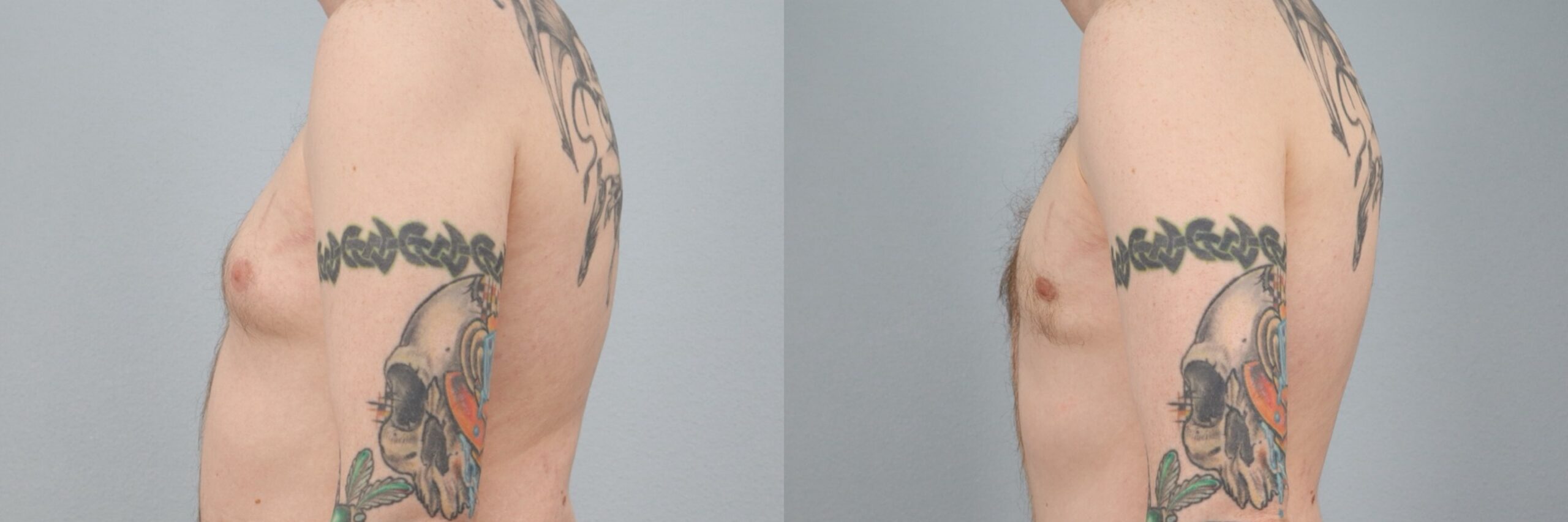 Before and after – Male Surgery – Male patient, age 30-39 – Image 18