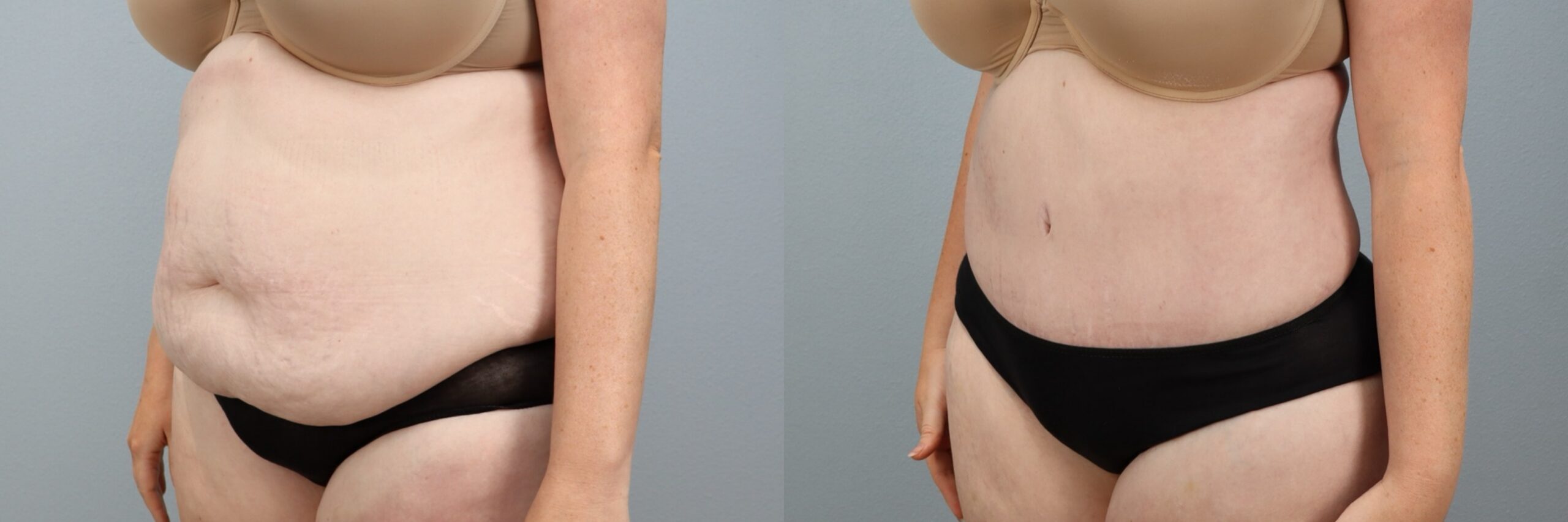 Before and after – Body Contouring – Female patient, age 30-39 – Image 2