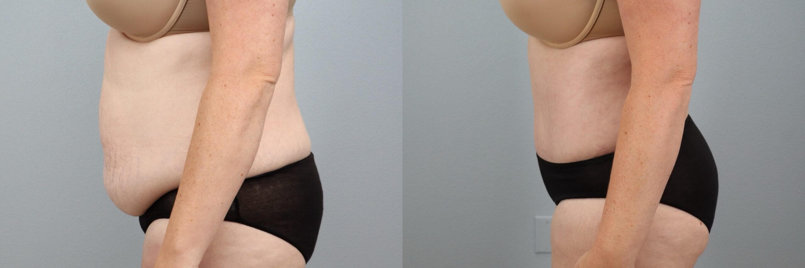 Before and after – Body Contouring – Female patient, age 30-39 – Image 3