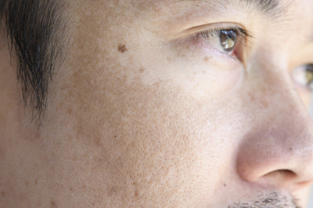 melasma on cheek