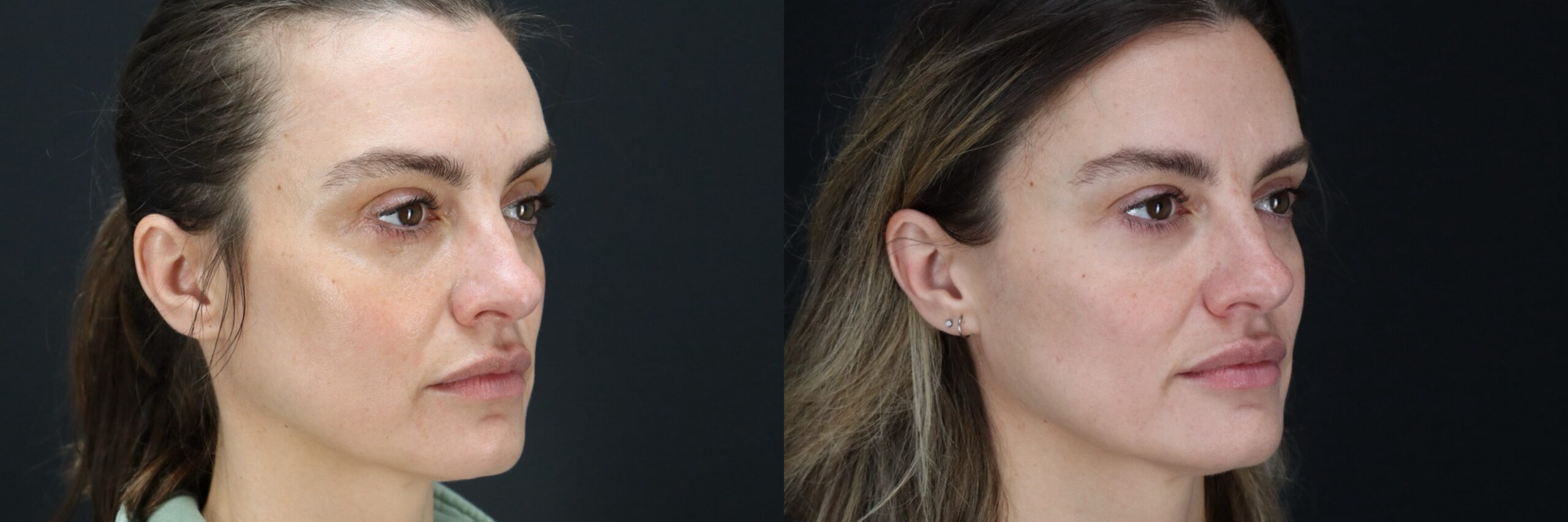 Before and after – Medi Spa – Female patient, age 40-49 – Image 38