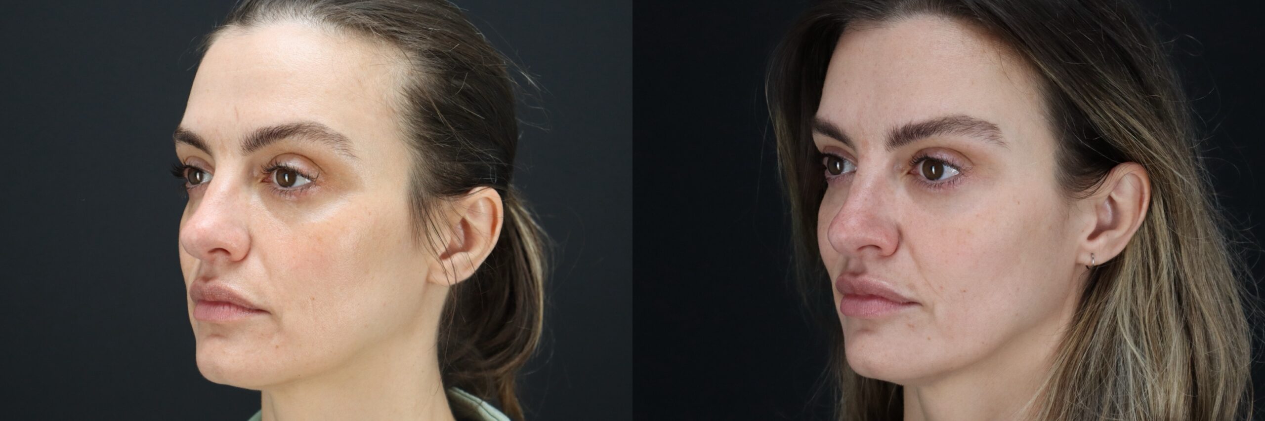 Before and after – Medi Spa – Female patient, age 40-49 – Image 37