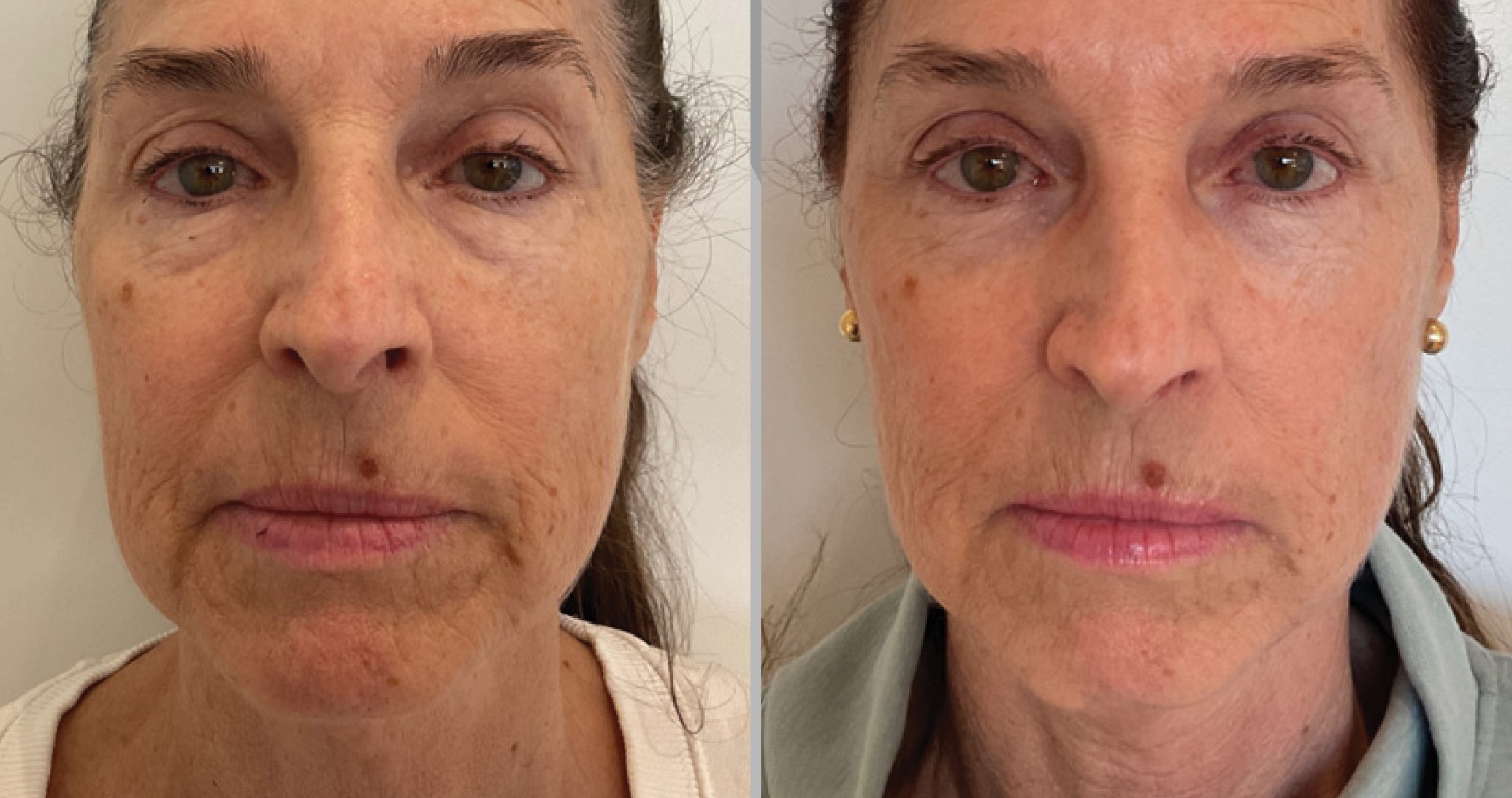 Before and after – XERF – Female patient, age 40-49 – Image 3