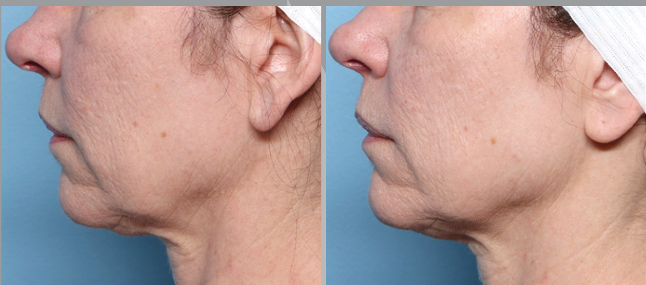 Before and after – XERF – Female patient, age 40-49 – Image 1
