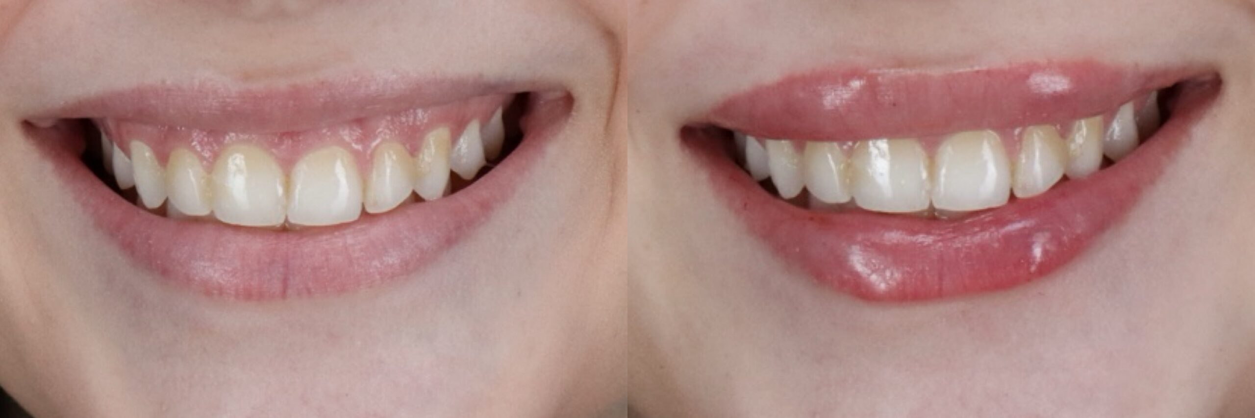 Before and after – Medi Spa – Female patient, age 20-29 – Image 40