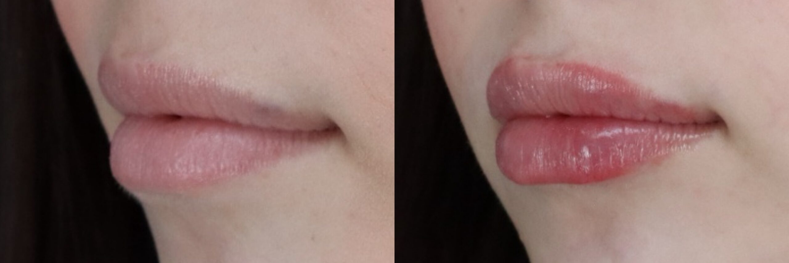 Before and after – Medi Spa – Female patient, age 20-29 – Image 41