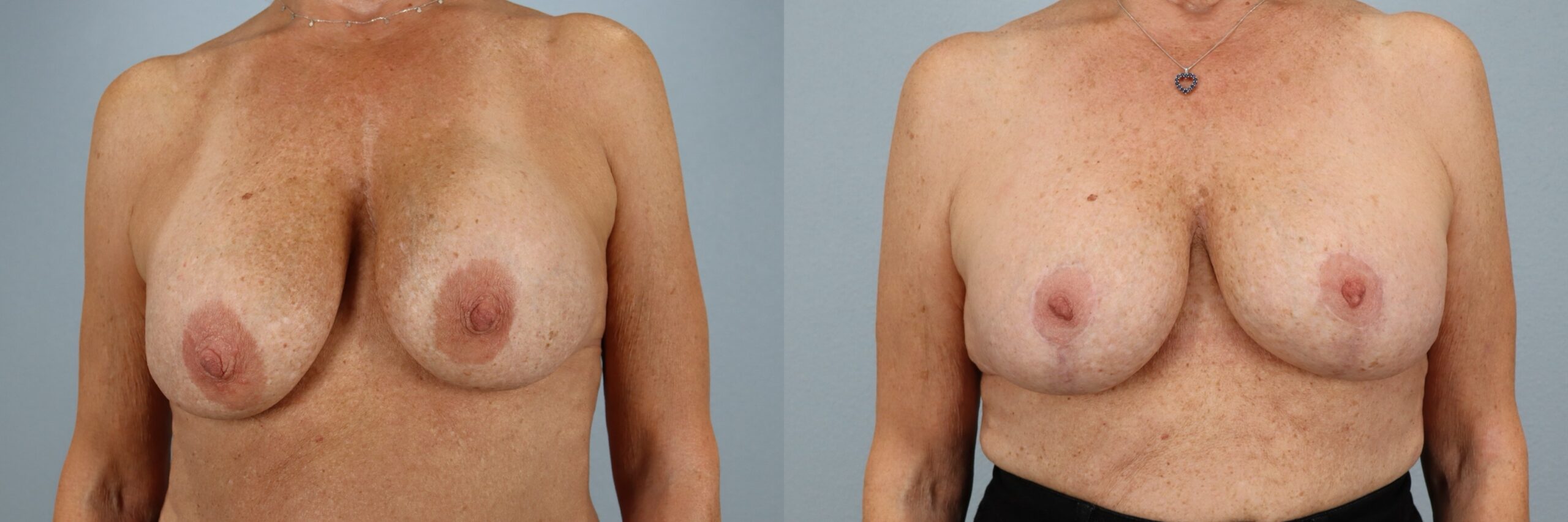 Before and after – Breast Surgery – Female patient, age 60+ – Image 4