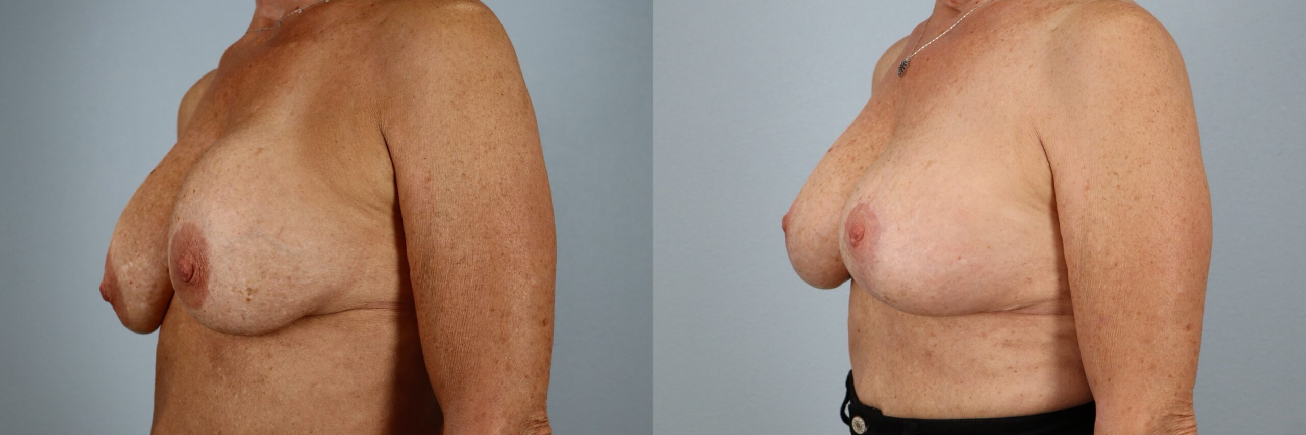 Before and after – Breast Surgery – Female patient, age 60+ – Image 5