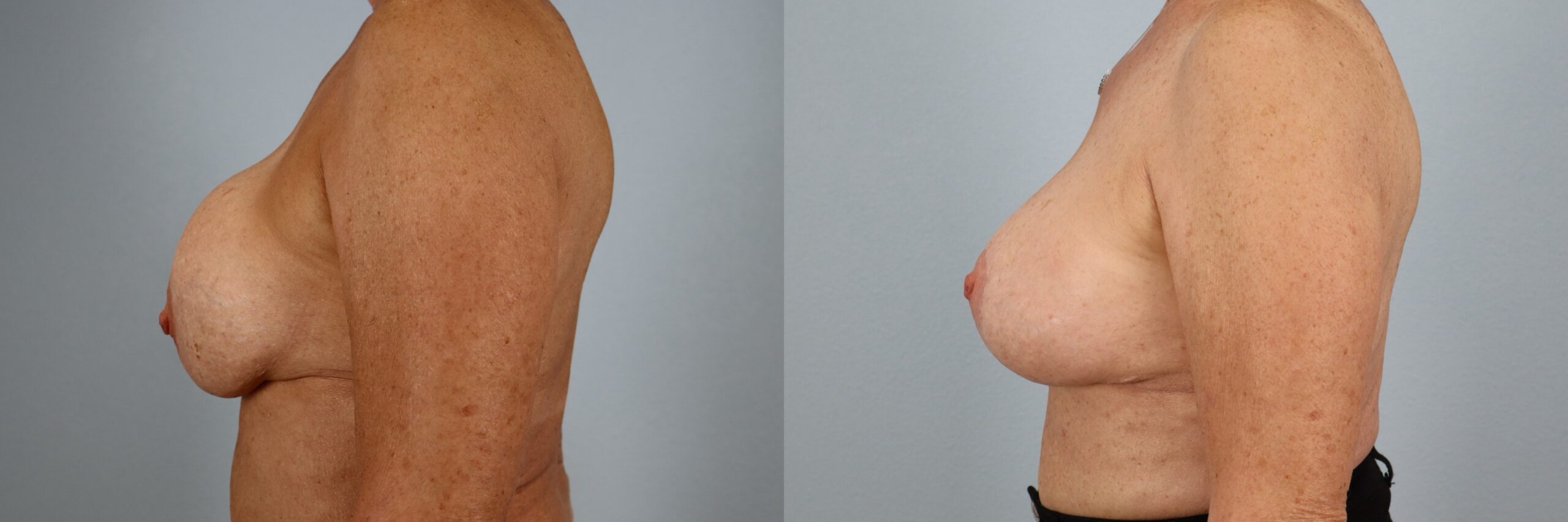 Before and after – Breast Surgery – Female patient, age 60+ – Image 6