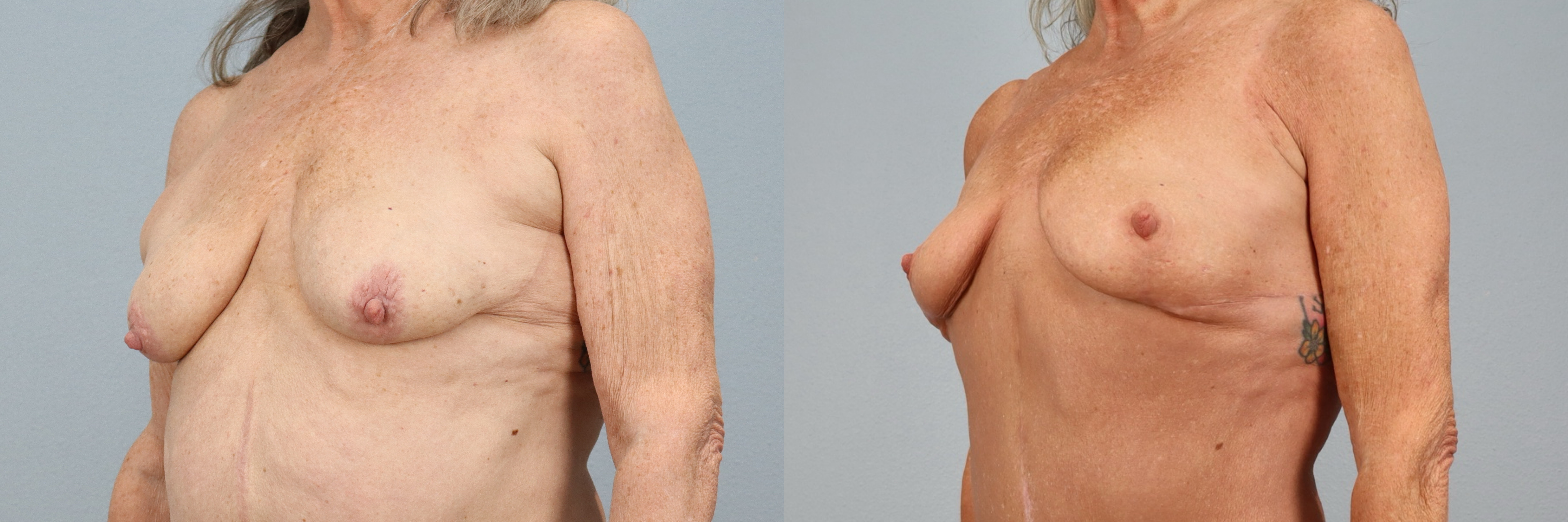 Before and after – Breast Surgery – Female patient, age 60+ – Image 8