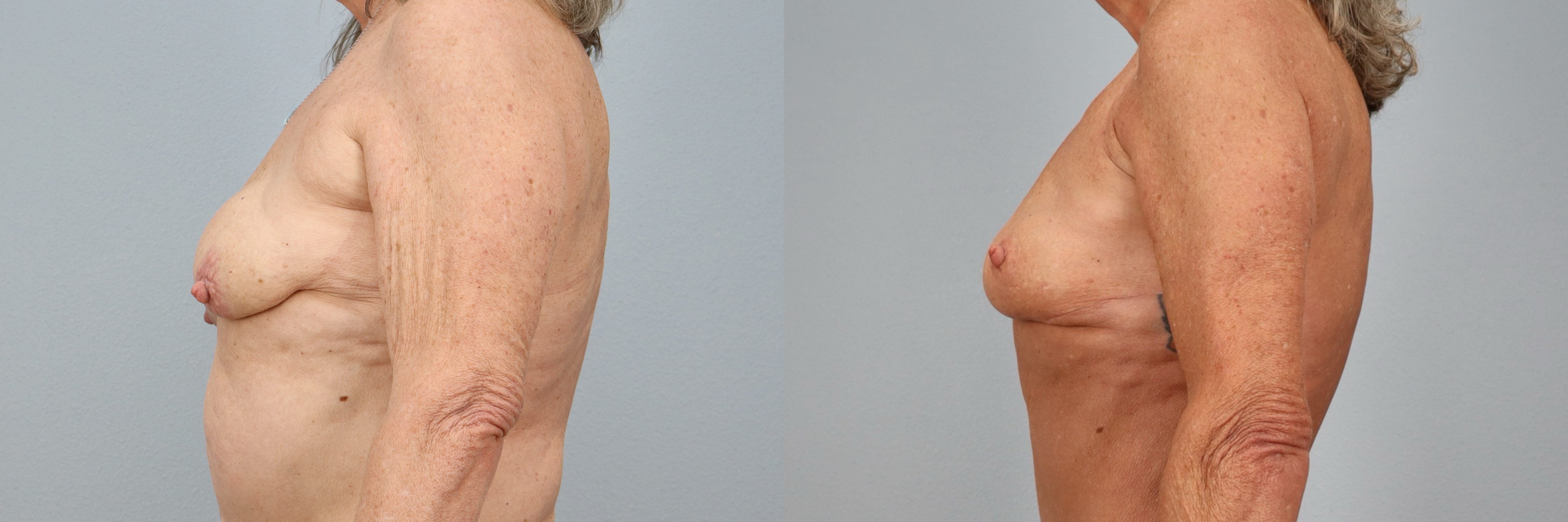 Before and after – Breast Surgery – Female patient, age 60+ – Image 9