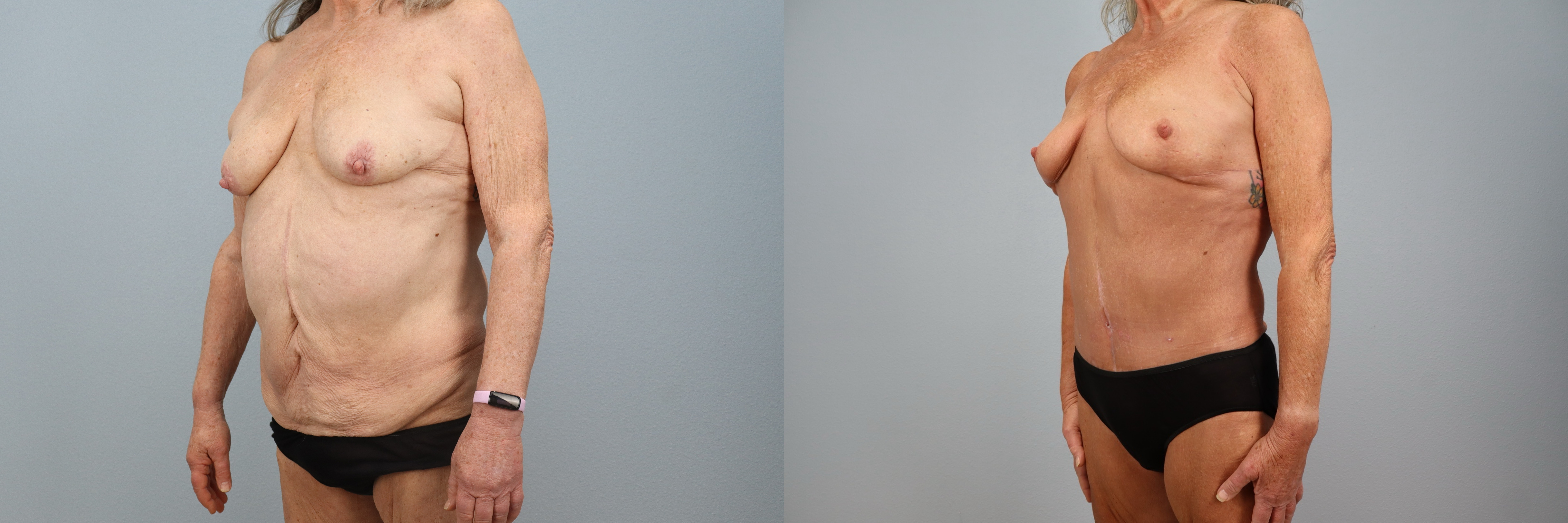 Before and after – Mommy Makeover – Female patient, age 60+ – Image 50