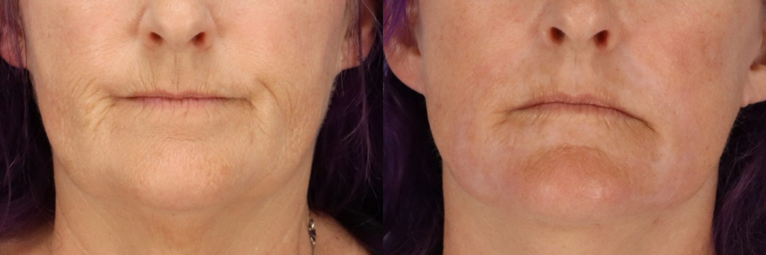 Before and after – Facial Surgery – Female patient, age 60+ – Image 36
