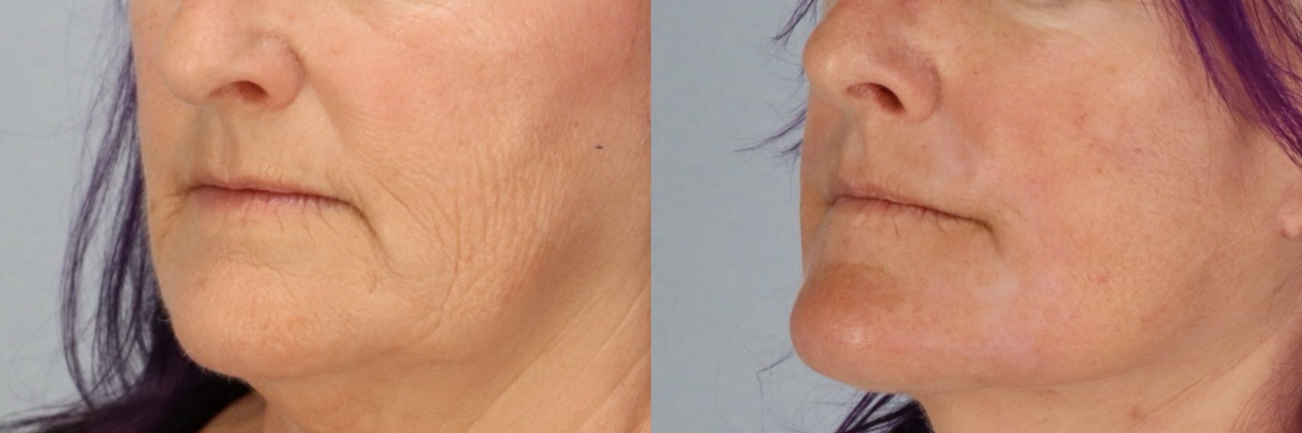 Before and after – Facial Surgery – Female patient, age 60+ – Image 37