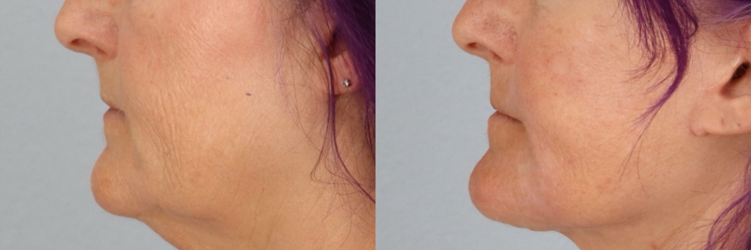 Before and after – Facial Surgery – Female patient, age 60+ – Image 38