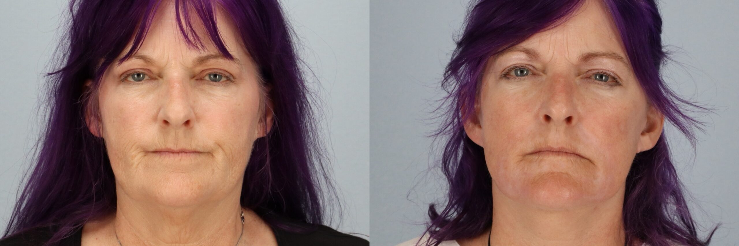 Before and after – Facial Surgery – Female patient, age 60+ – Image 25