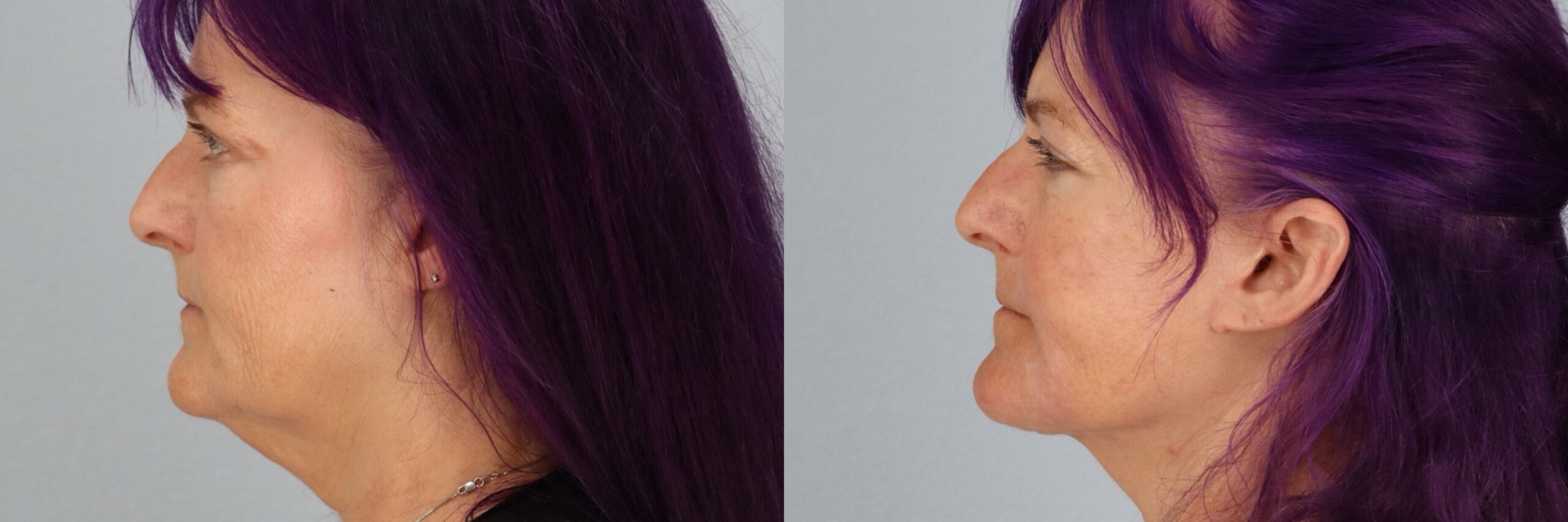 Before and after – Facial Surgery – Female patient, age 60+ – Image 27