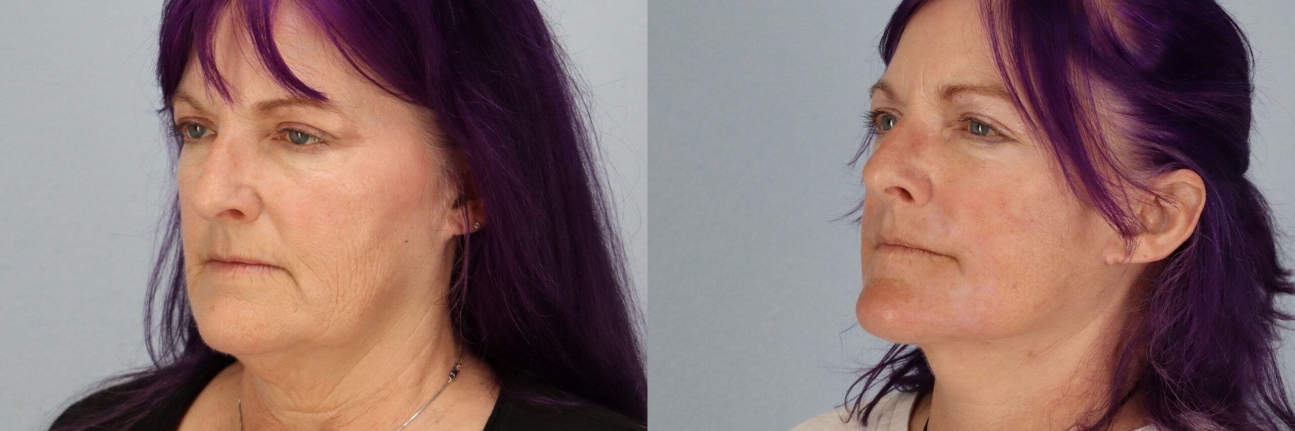 Before and after – Facial Surgery – Female patient, age 60+ – Image 26
