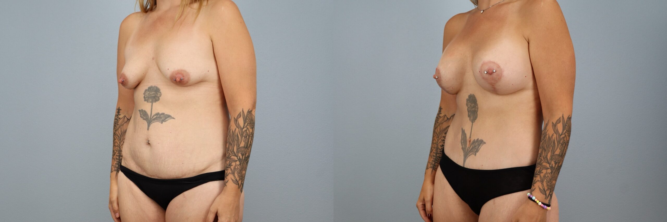 Before and after – Mommy Makeover – Female patient, age 40-49 – Image 38