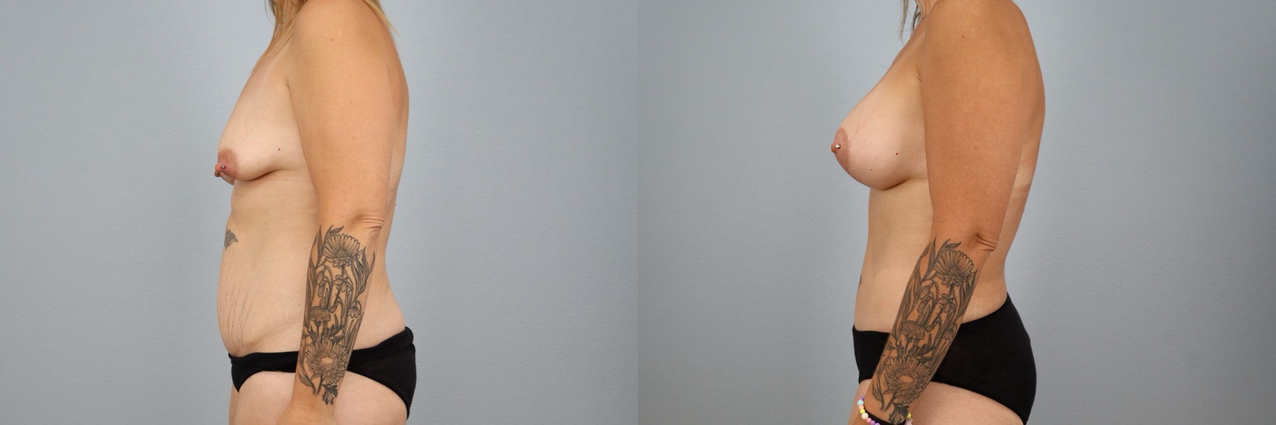Before and after – Mommy Makeover – Female patient, age 40-49 – Image 39