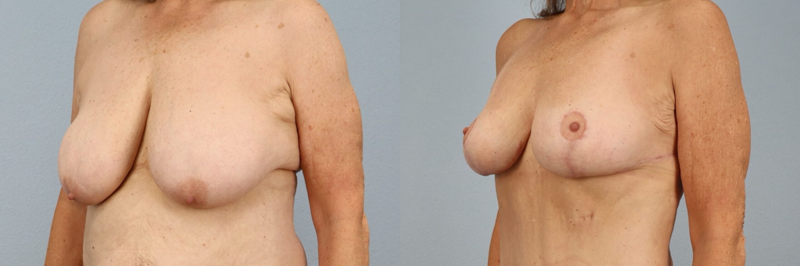 Before and after – Breast Surgery – Female patient, age 60+ – Image 5