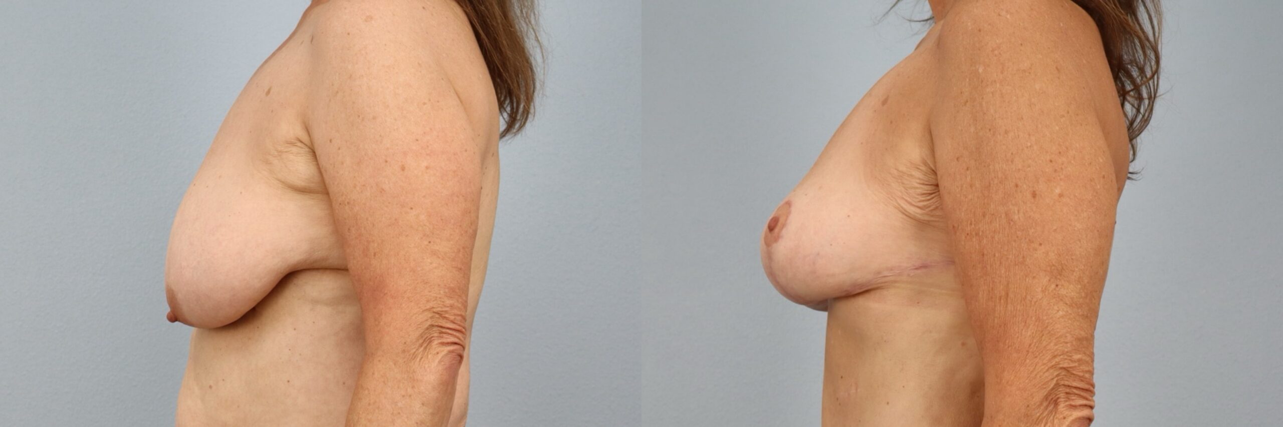 Before and after – Breast Surgery – Female patient, age 60+ – Image 6