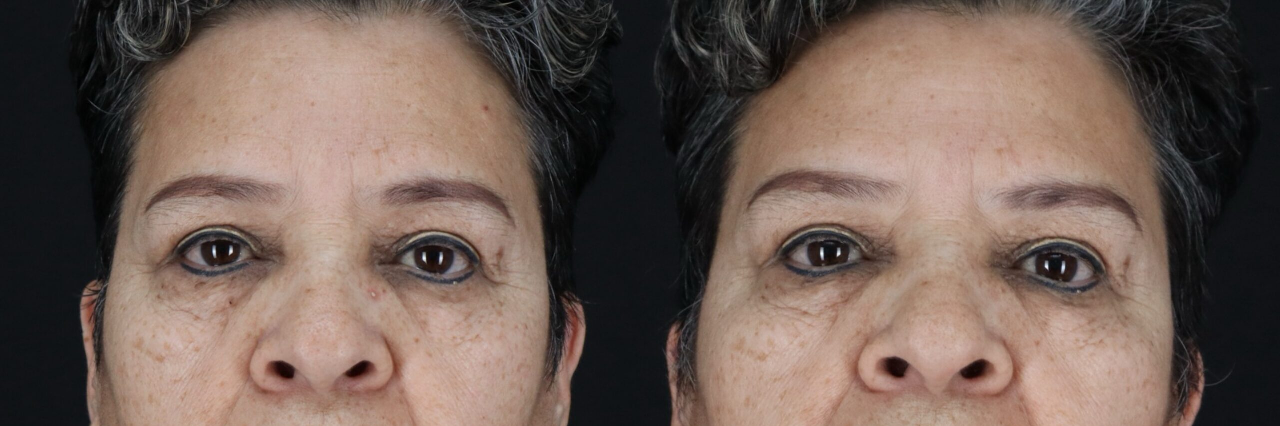 Before and after – Medi Spa – Female patient, age 60+ – Image 20