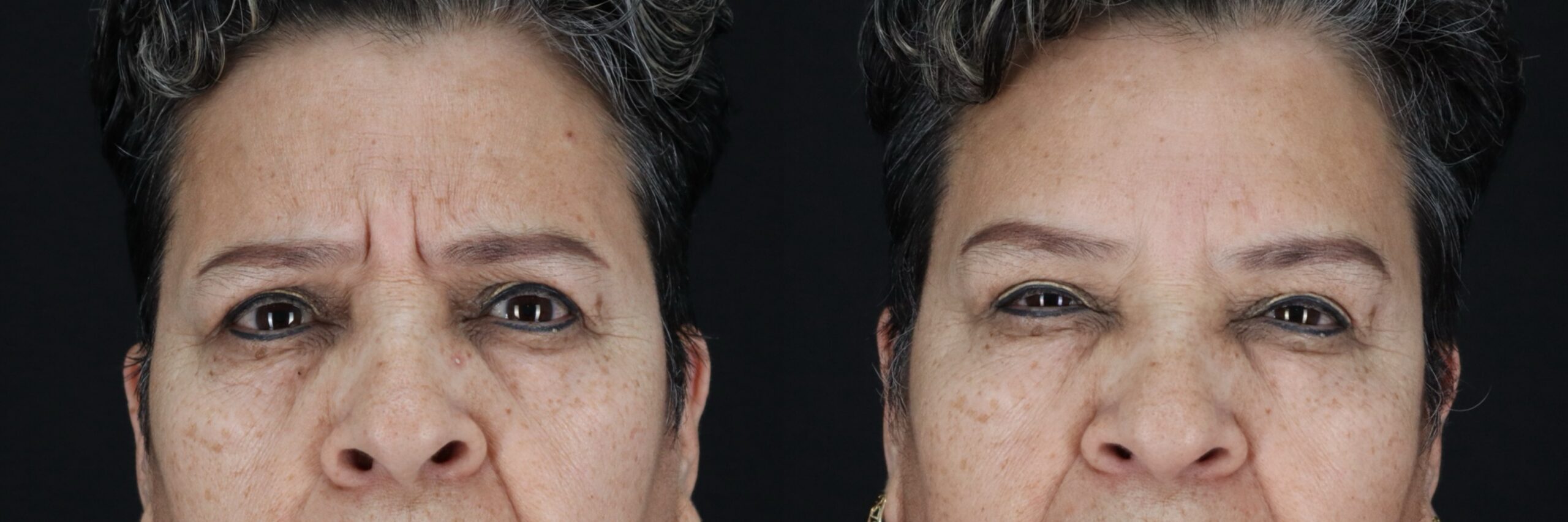 Before and after – Medi Spa – Female patient, age 60+ – Image 22