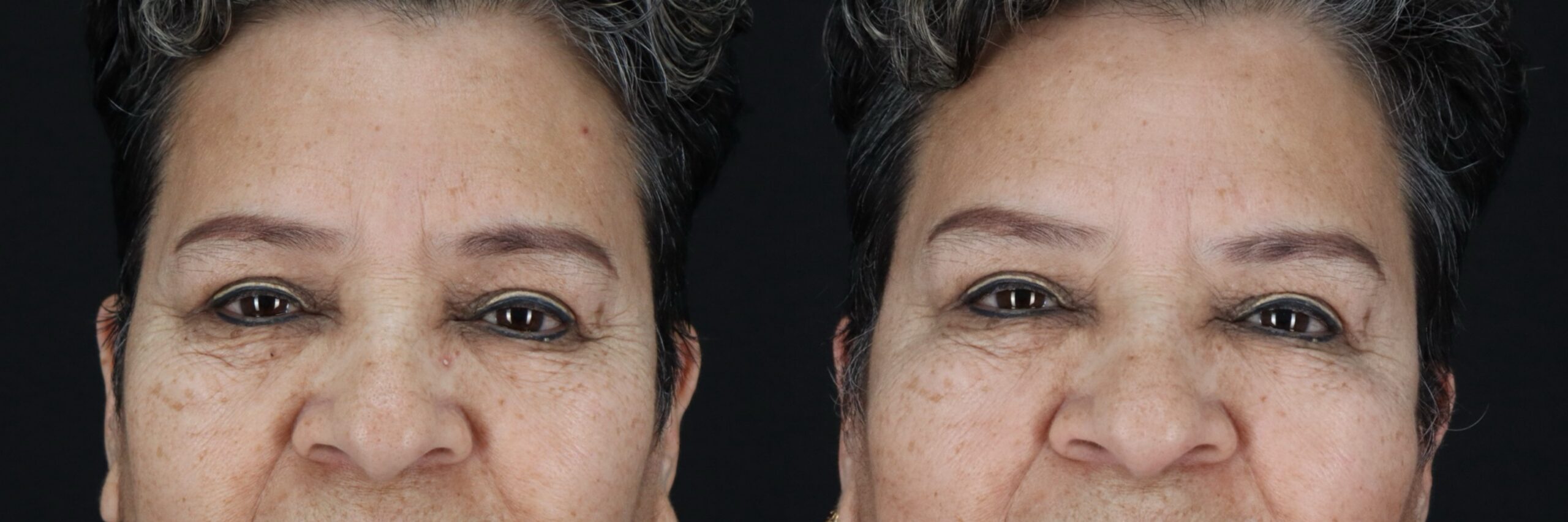 Before and after – Medi Spa – Female patient, age 60+ – Image 21
