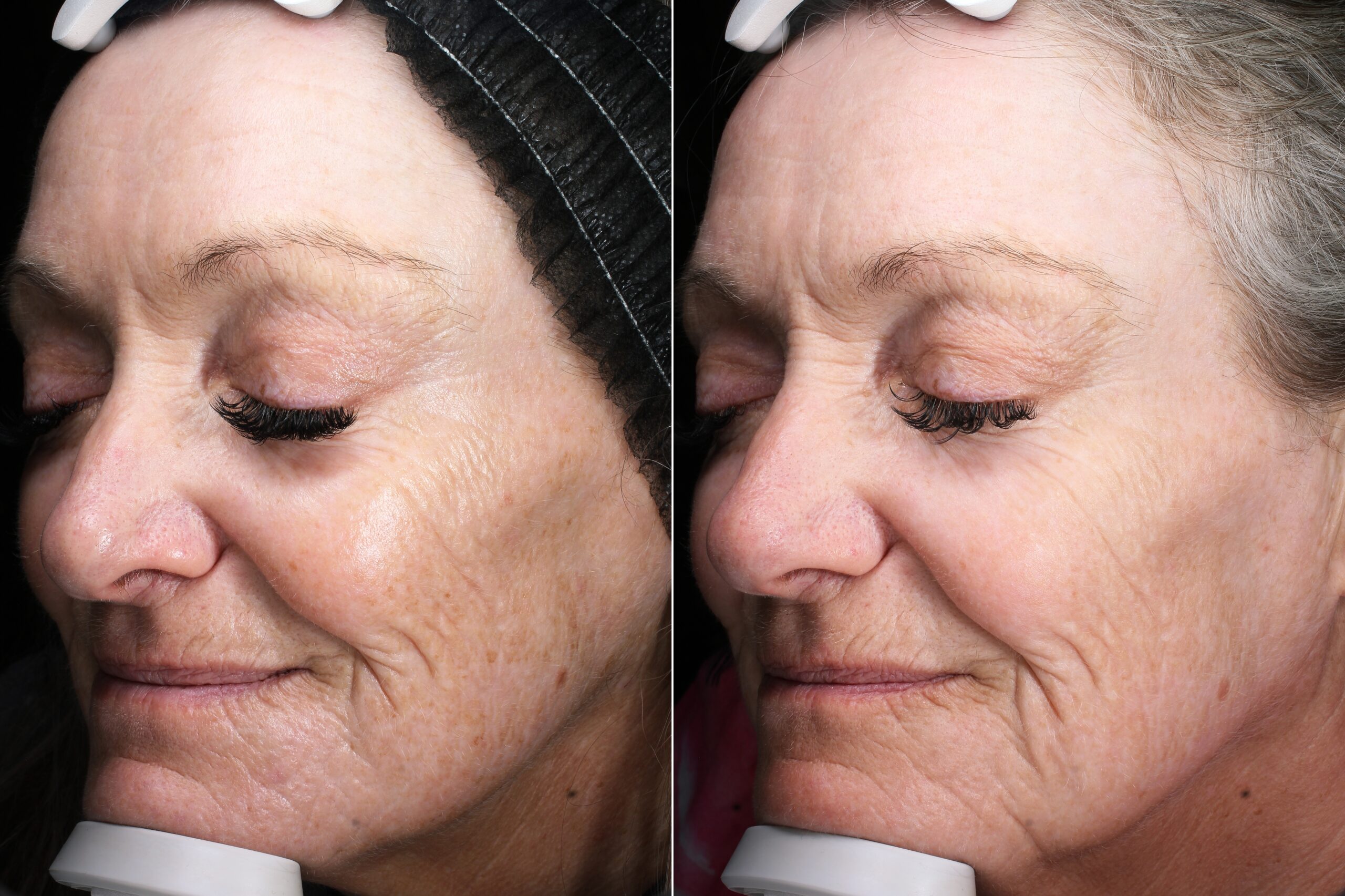 Before and after – Filler – Female patient, age 60+ – Image 8