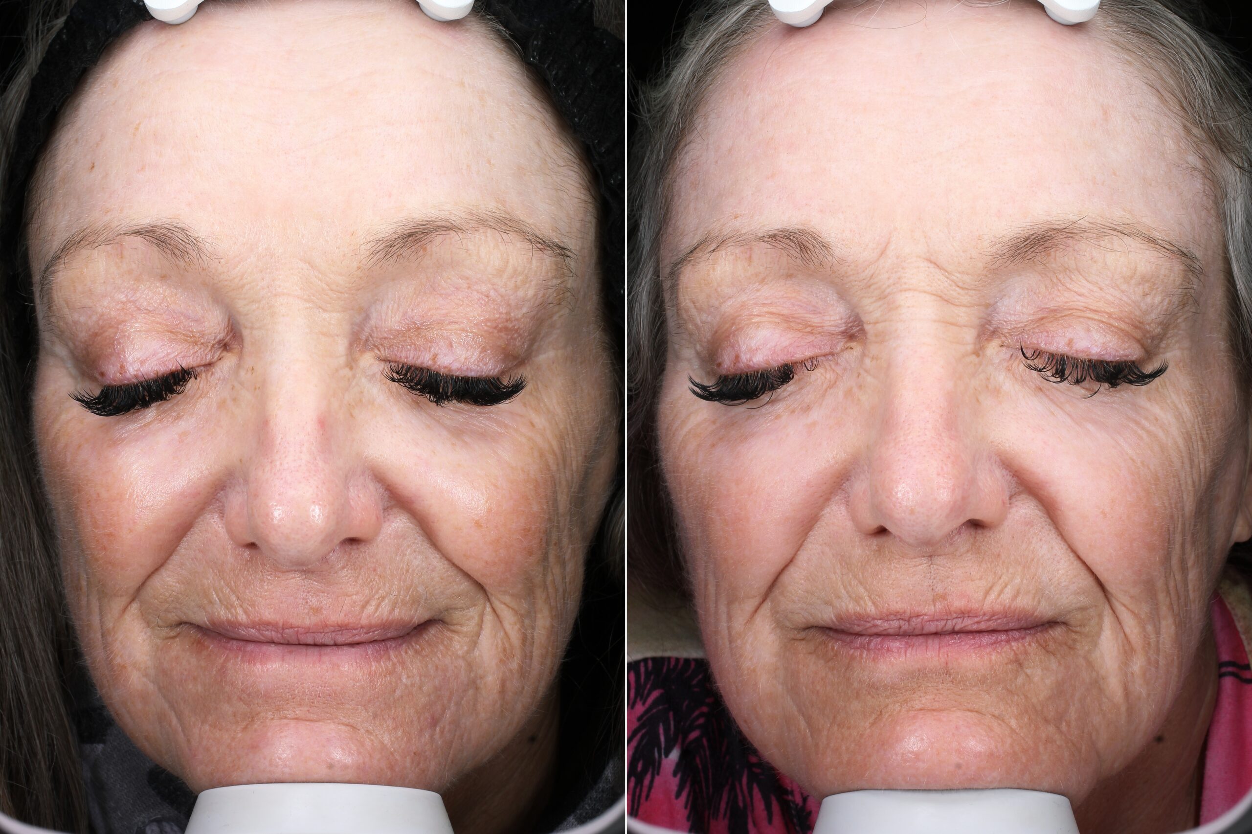 Before and after – Filler – Female patient, age 60+ – Image 7
