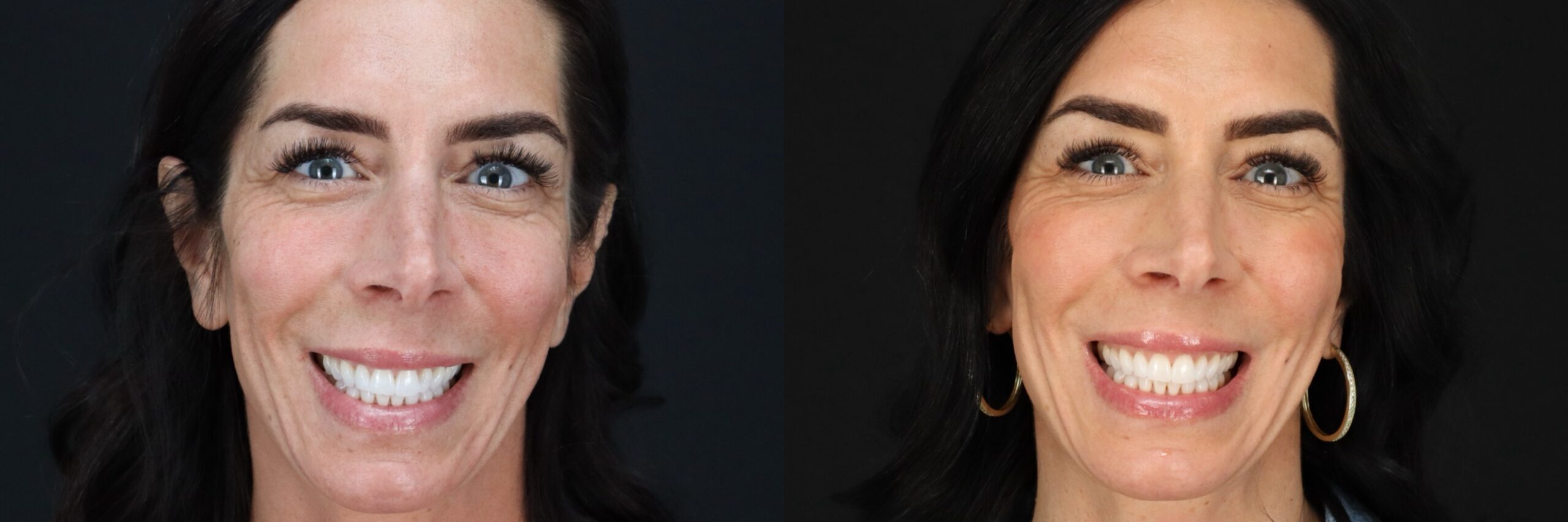 Before and after – Medi Spa – Female patient, age 40-49 – Image 17