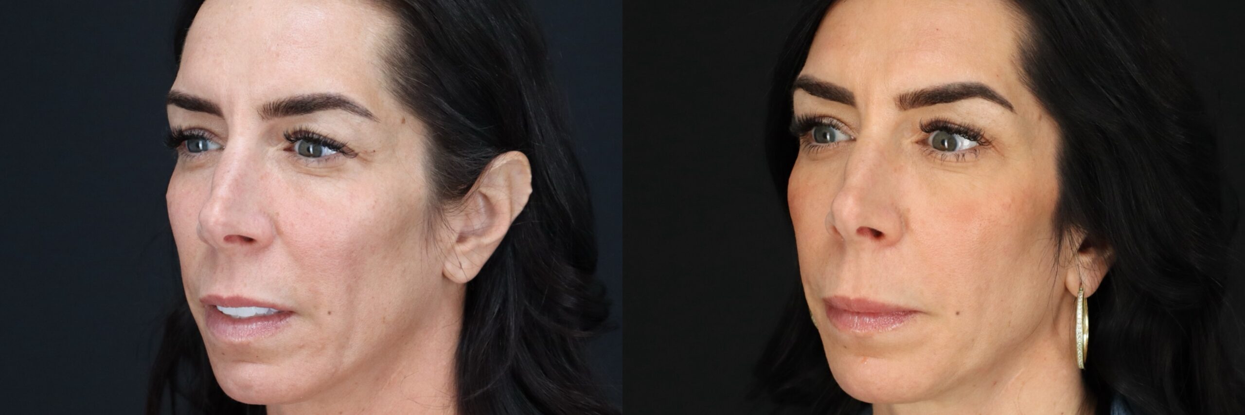Before and after – Medi Spa – Female patient, age 40-49 – Image 18
