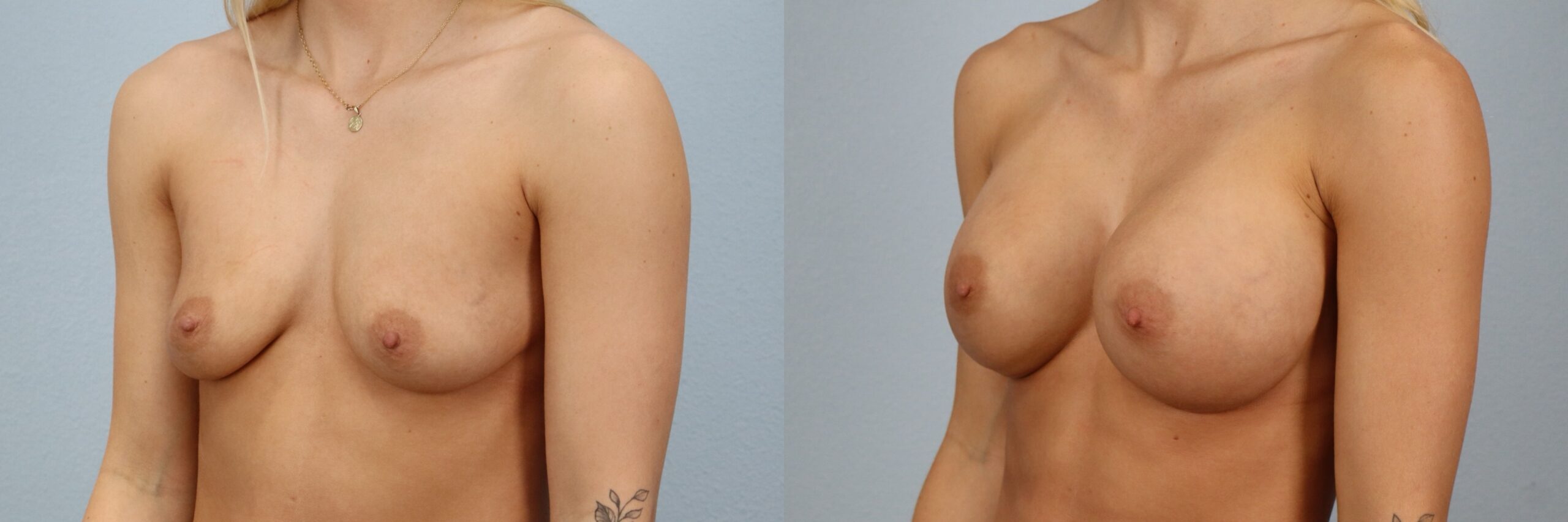 Before and after – Breast Augmentation – Female patient, age 20-29 – Image 11